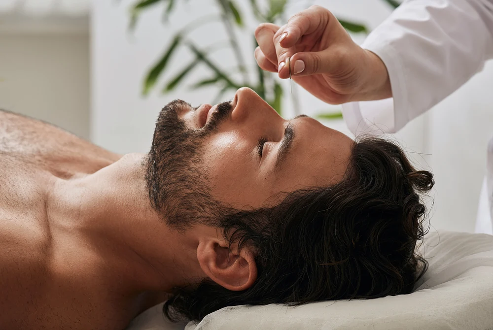 Acupunturista insere agulhas de acupuntura em ponto na cabeça de paciente homem